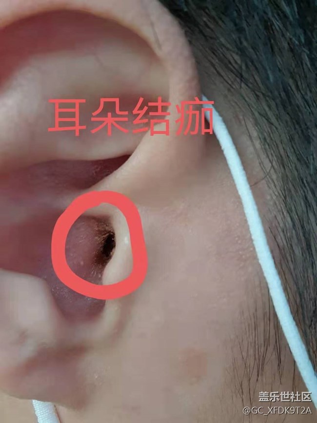 Buds pro 佩戴耳朵反复发炎流水结痂