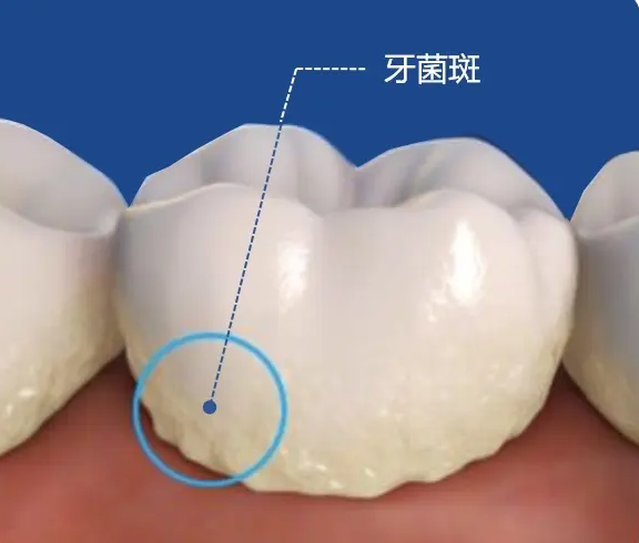 电动牙刷该如何选购？博主提醒四大危害误区不得不防
