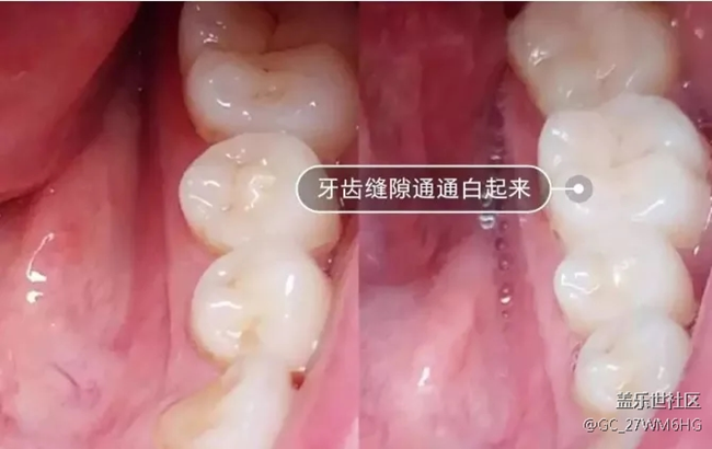 电动牙刷出血正常吗？四大伤牙危害要警惕！