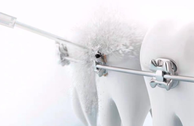 正畸需要冲牙器吗？这三大伤牙误区务必注意！