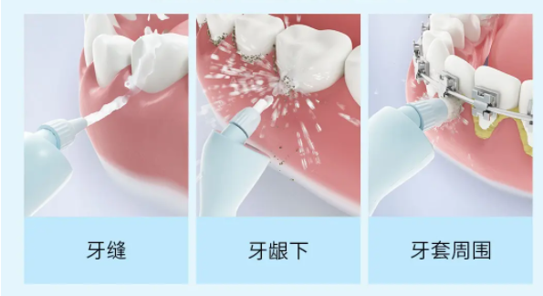 如何正确选购冲牙器？四大伤牙误区要警惕！