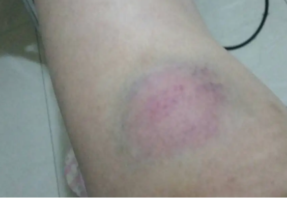 筋膜枪有坏处吗？三大危害副作用不得不防！